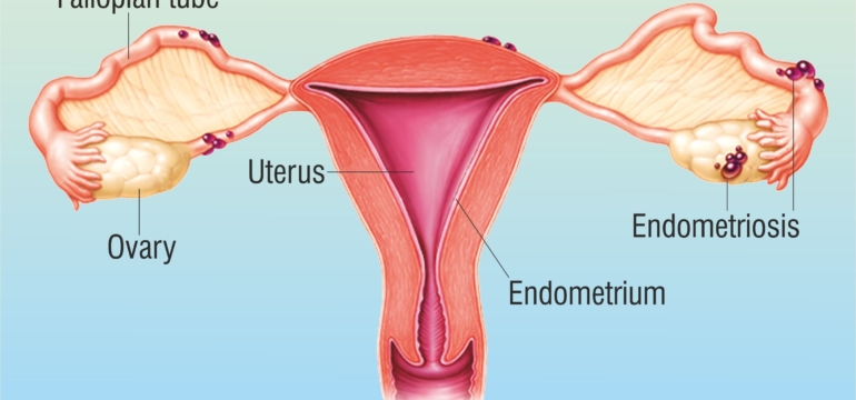 Relationship between pelvic pain and diagnosis of endometriosis