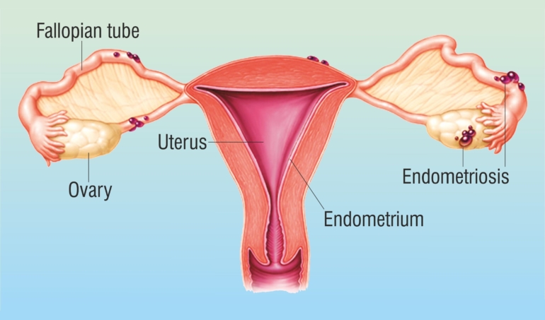 Relationship between pelvic pain and diagnosis of endometriosis